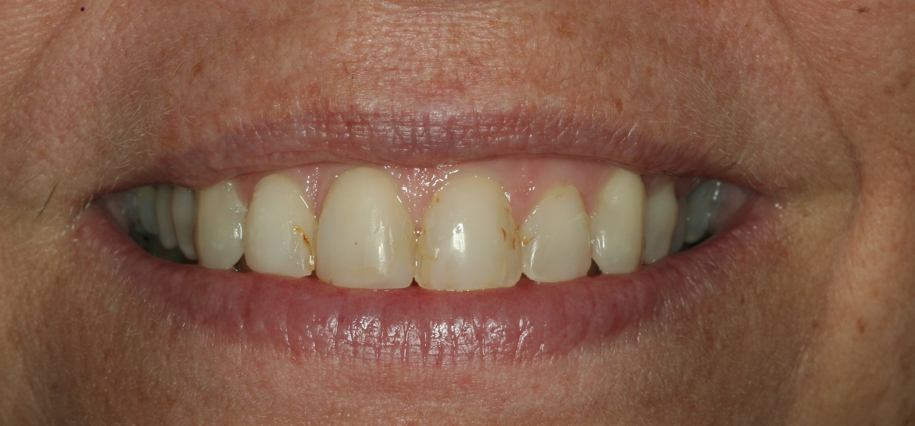 Stained Teeth - Beverly Restorative and Implant Dentistry Center