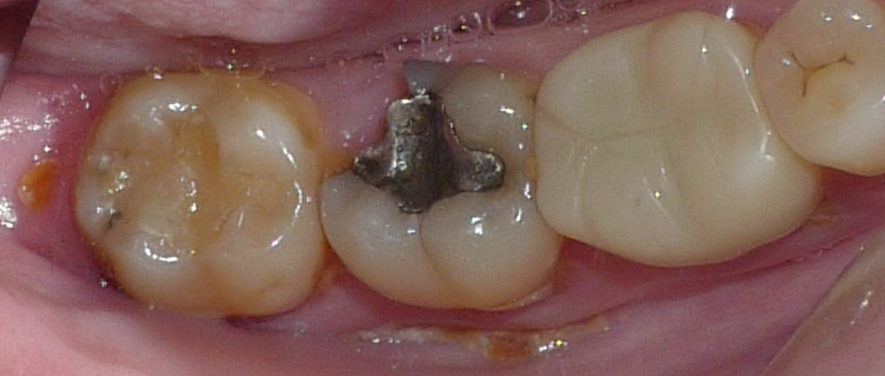 broken crown before tooth fix teeth dental source